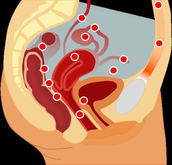 borová děloha s endometriózou