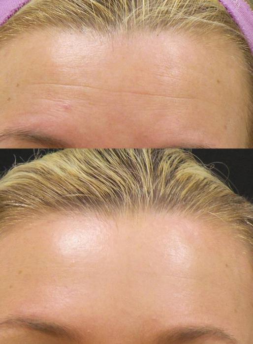 botulotoxinová terapie v kosmetologii
