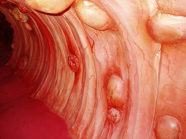 simptomi in manifestacije raka črevesja