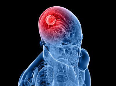 příznaky rakoviny mozku