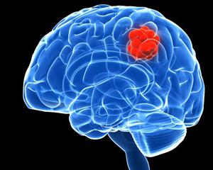 příznaky rakoviny mozku