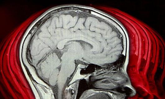 Mozková encefalopatie