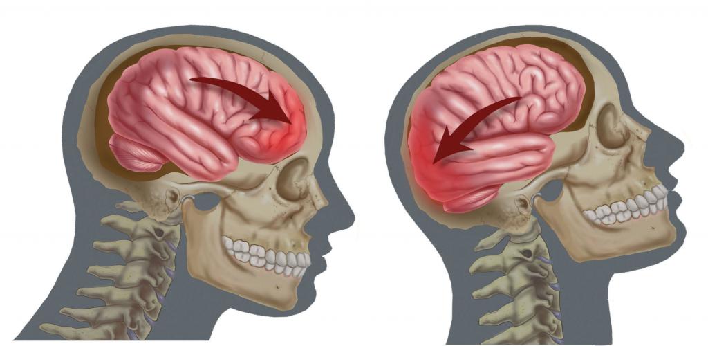 epiduralnega hematoma možganov