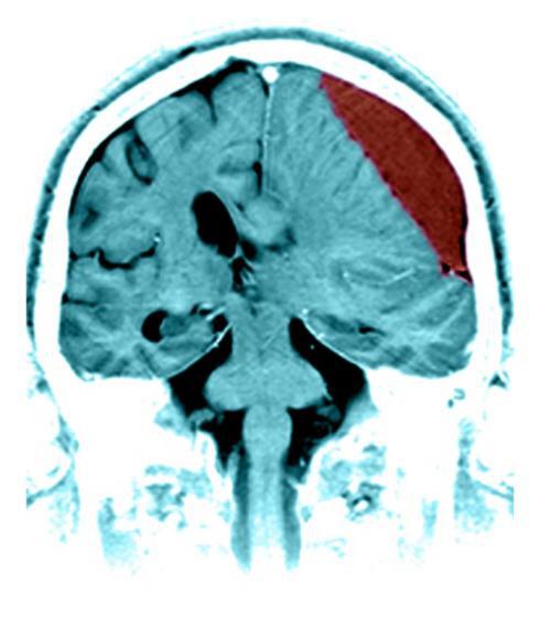 ematoma conseguenze della chirurgia cerebrale