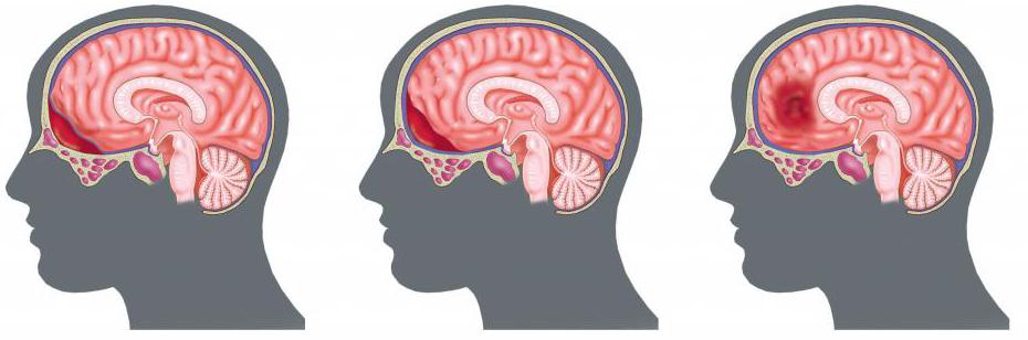 možganski hematom