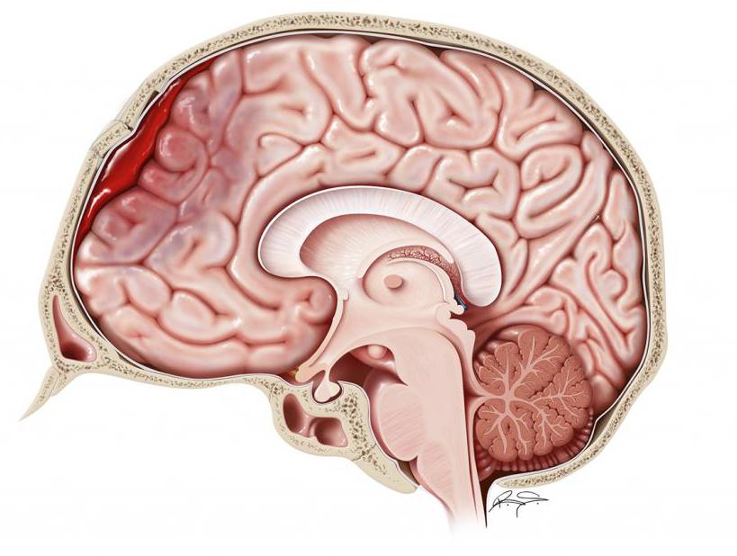 zdravljenje možganskega hematoma