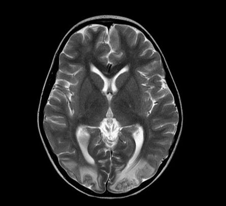 možganski hidrocefalus
