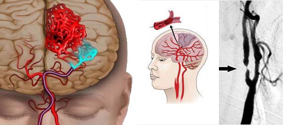 Liječenje poremećaja moždane cirkulacije