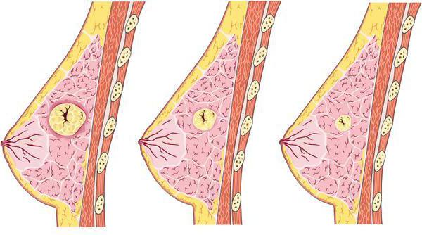 fibroadenoma al seno di cosa si tratta