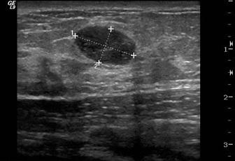 ultrazvuk dojke na koji dan