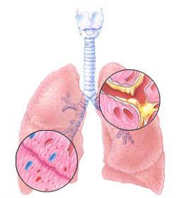 classificazione della bronchite