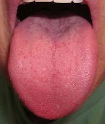 лечение на изгарящ език