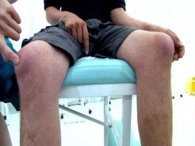 симптоми бурситиса колена