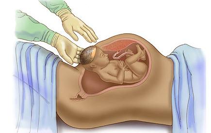anestesia per taglio cesareo