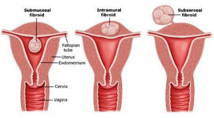możesz zajść w ciążę z małymi mięśniakami macicy