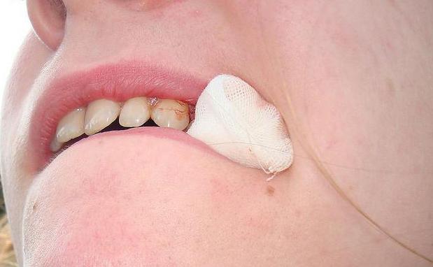 di risciacquare la bocca dopo l'estrazione del dente