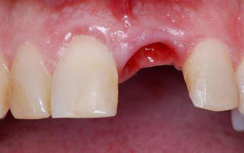 Isperite usta nakon vađenja zuba