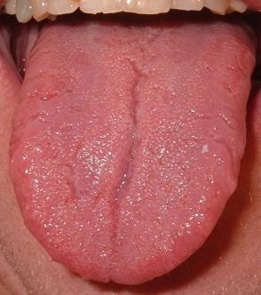 cancro della lingua