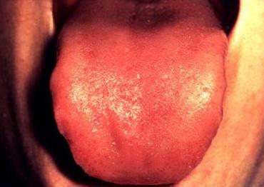 симптоми на рак на езика