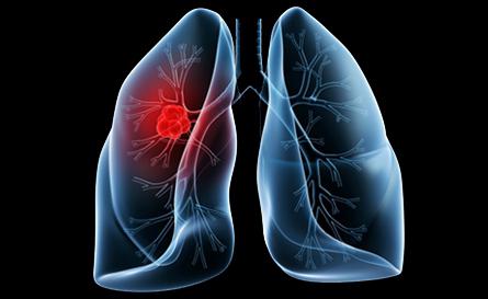 Trattamento del cancro polmonare