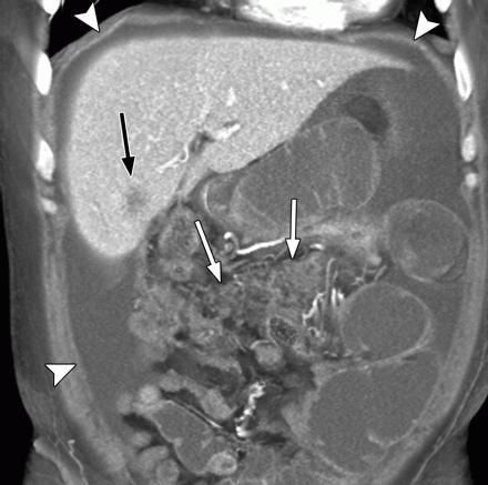 carcinoma peritoneale