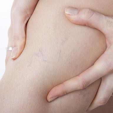 maglia capillare sulle gambe durante la gravidanza