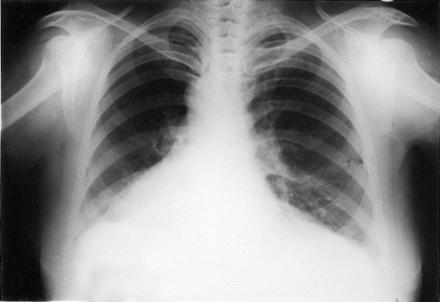 nouze v oblasti srdeční astmatu