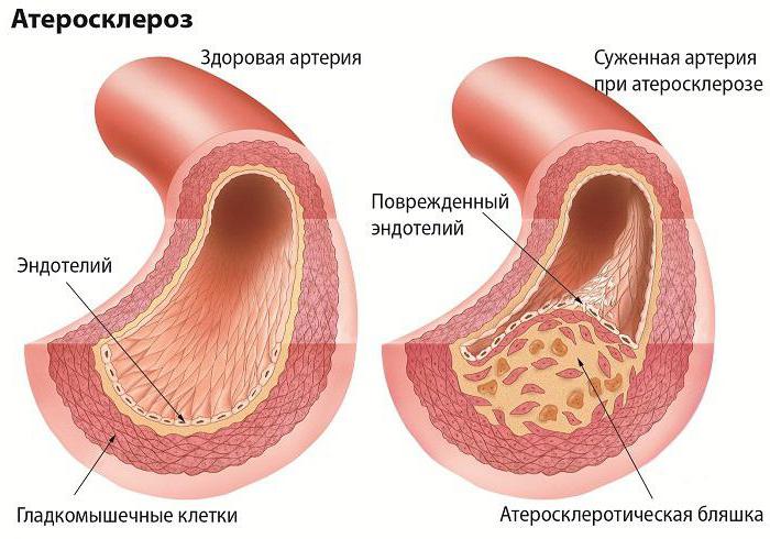 leczenie zwapnienia tętnic szyjnych