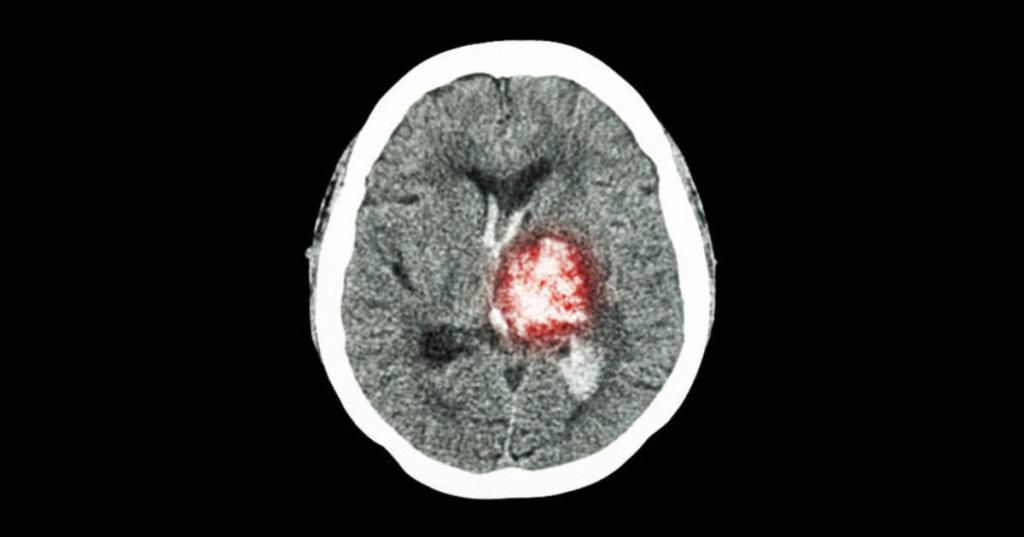 MRI za moždani udar
