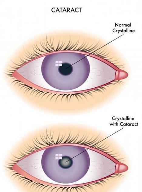 zdravljenje očesne mrene