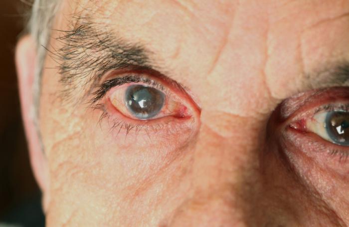 Szemcseppek a látás javítására - válasszuk ki a legjobbat Vitamincseppek, amelyek javítják a látást