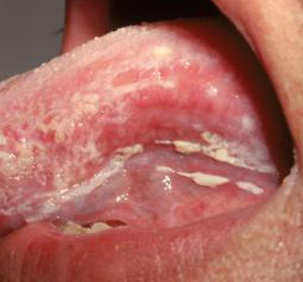 příznaky drozd u mužů v ústech