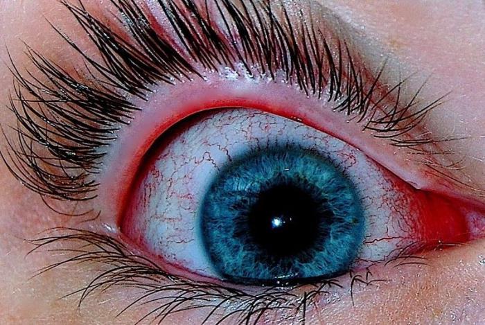 Příčiny zčervenání očí