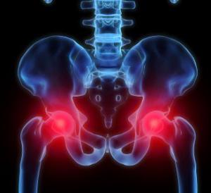 Osteoartritis: Kako izbjeći kirurški zahvat Orthokin terapijom
