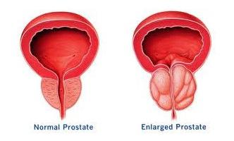 symptomy prostatitidy