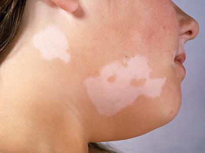 příčiny vitiligy