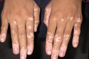 vitiligo způsobuje onemocnění