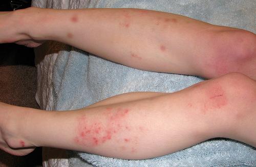 segni di eczema