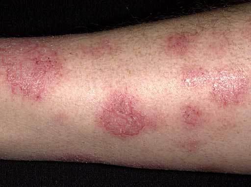 foto di eczema
