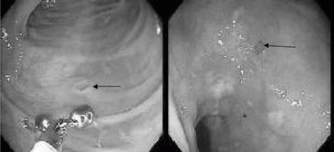Kauterizacija erozije materničnega vratu z laserjem