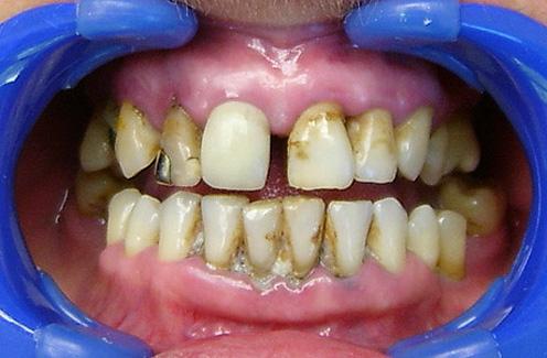 zubního kamene