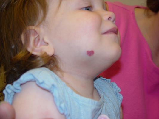 Pomanjkljiva hemangioma pri otroku