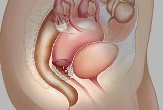 Kako se manifestira rak vrata maternice