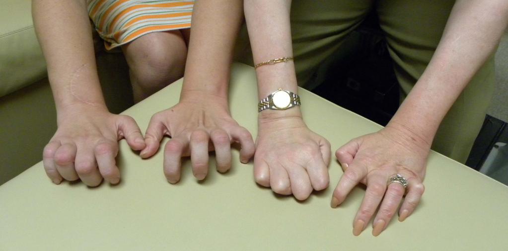 sintomi della mano