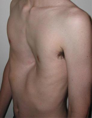deformacja klatki piersiowej