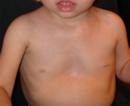 размразяване на гърдите при деца