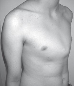 deformacija prsnega koša