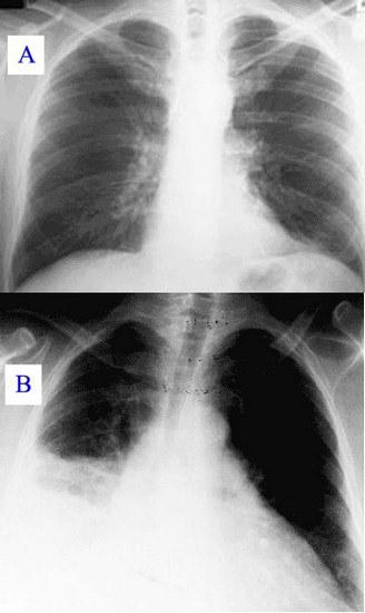 radiografia klatki piersiowej