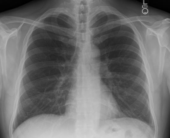 opći rendgenski snimak prsnog koša