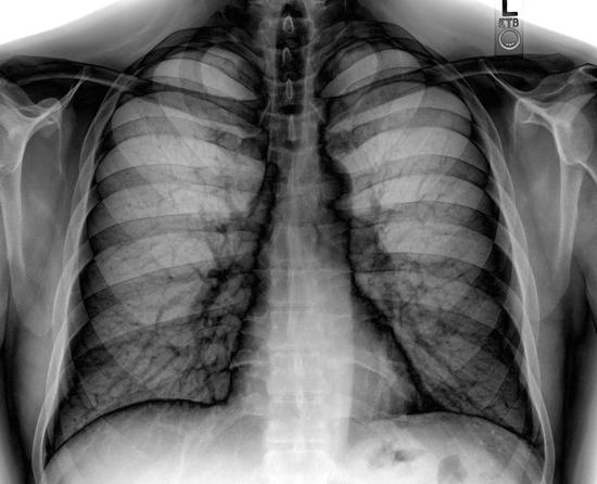 rendgenski snimak prsnog koša
